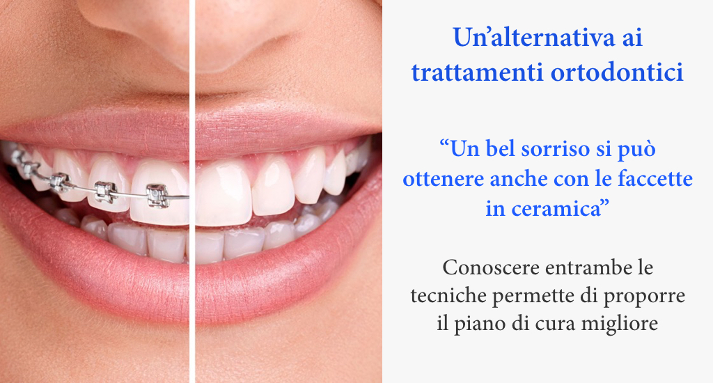 Alternativa apparecchio ortodontico, Dott. Francesco Santarlasci